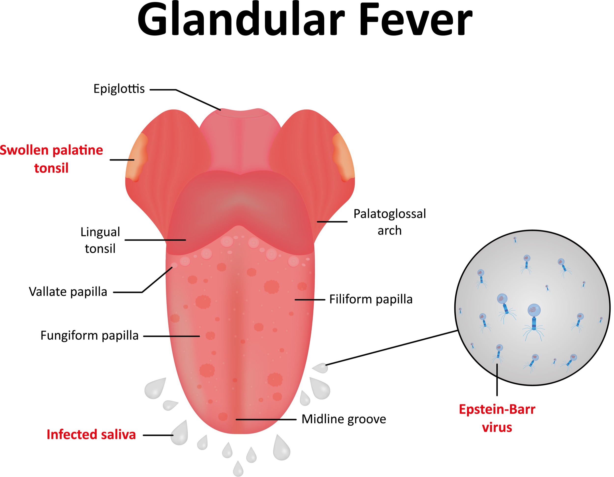 glandular fever images infectious diseases for presentations pictures